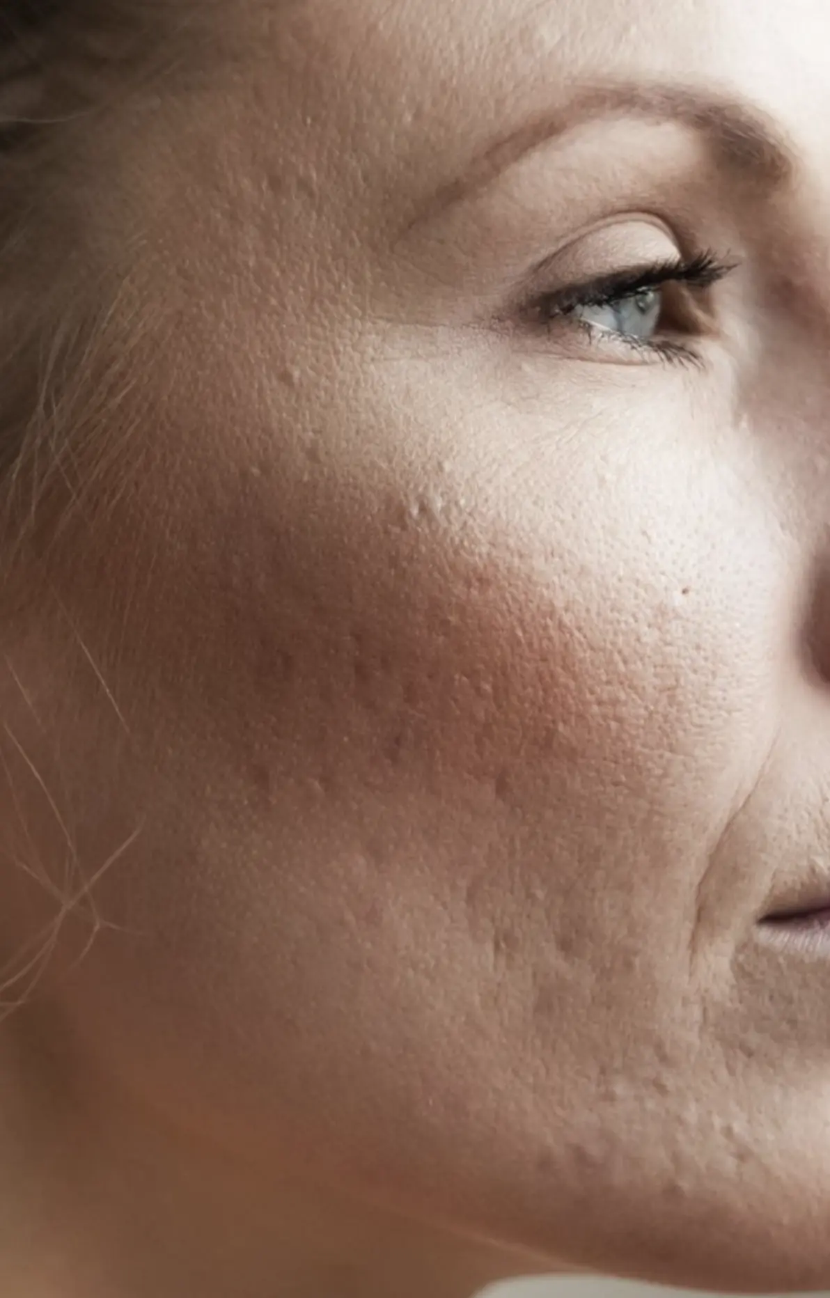 acne scar removal realistic expectations