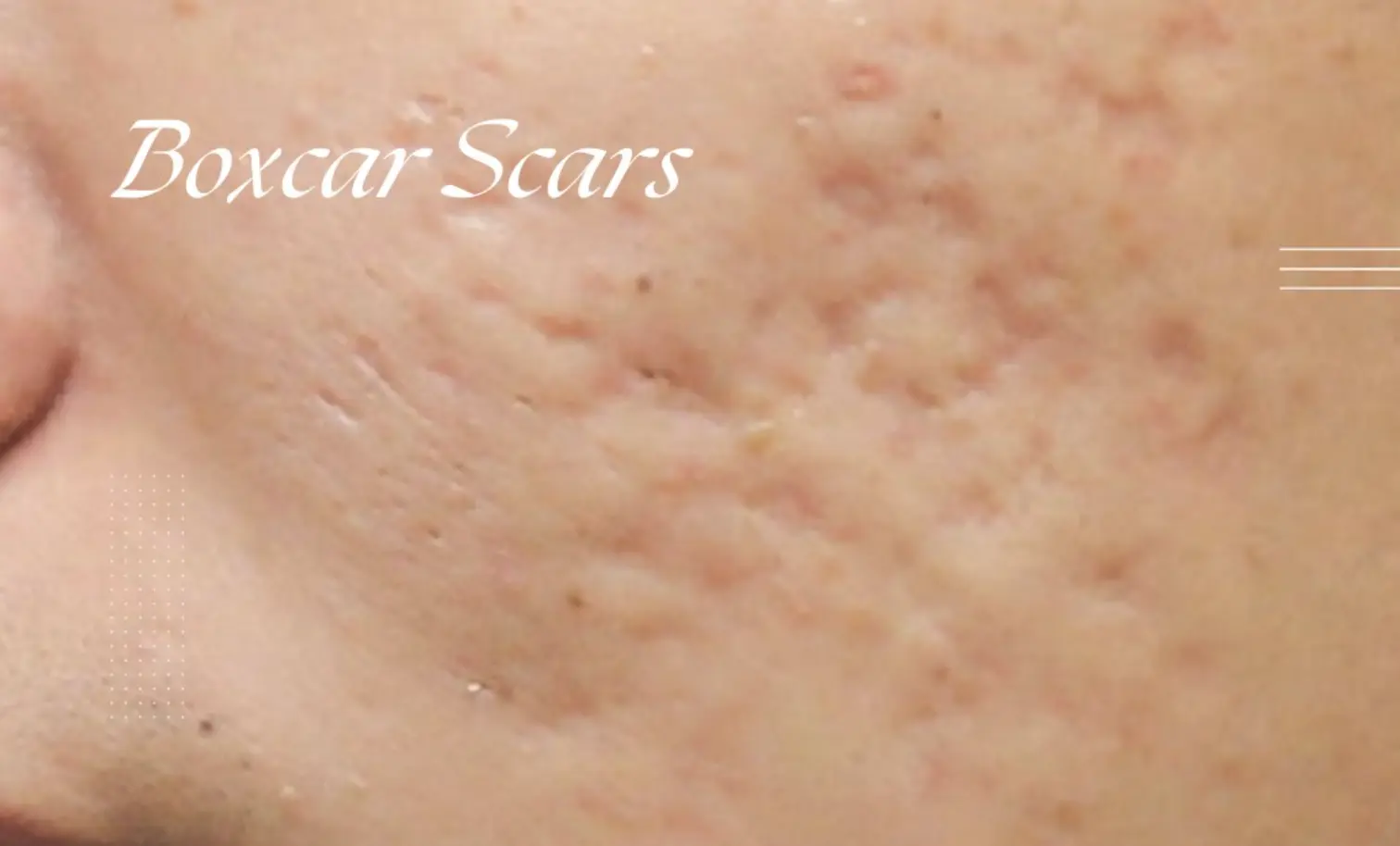 best treatments for acne scar reduction