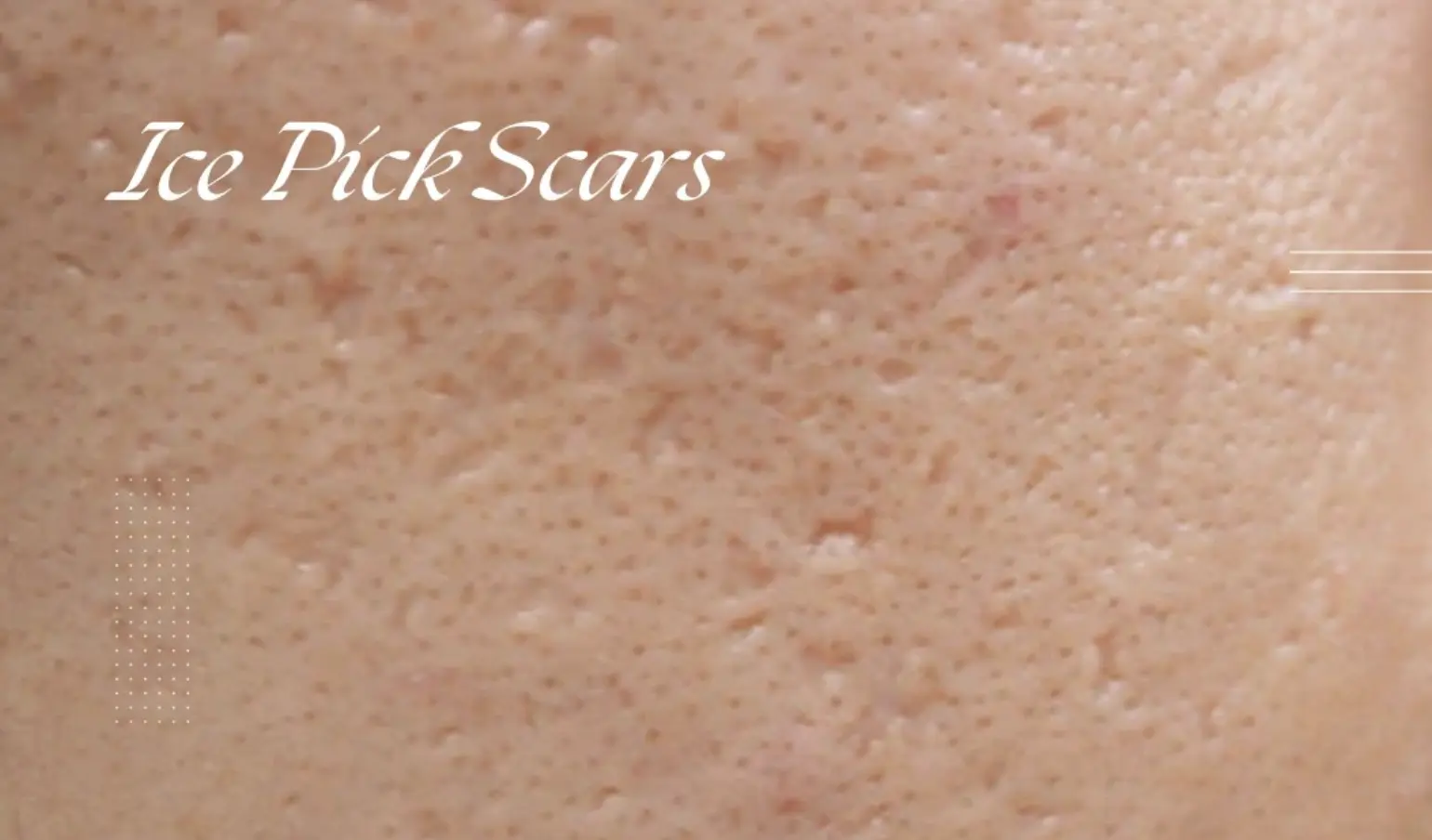 can acne scars disappear completely