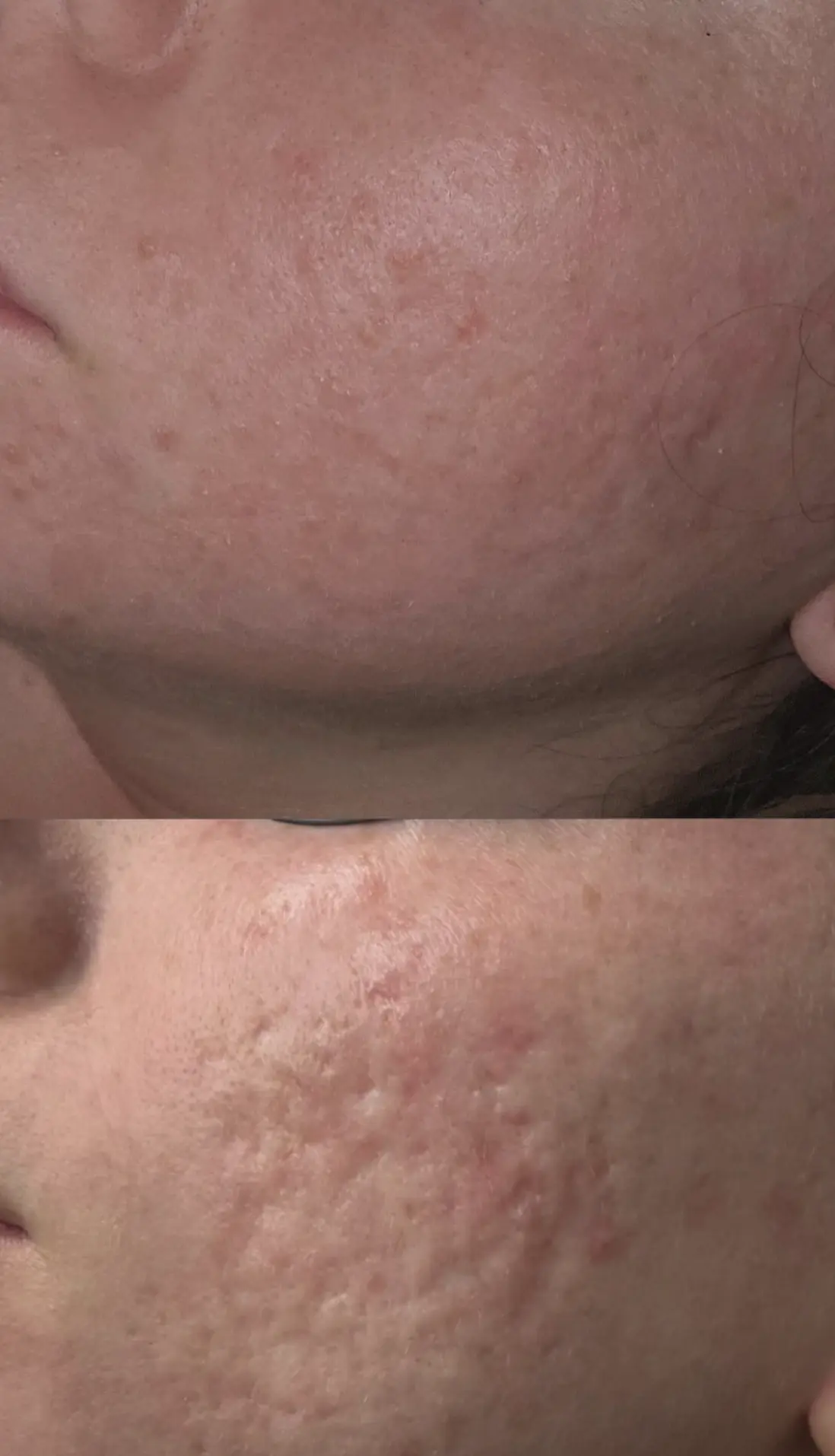 can you 100 percent remove acne scars