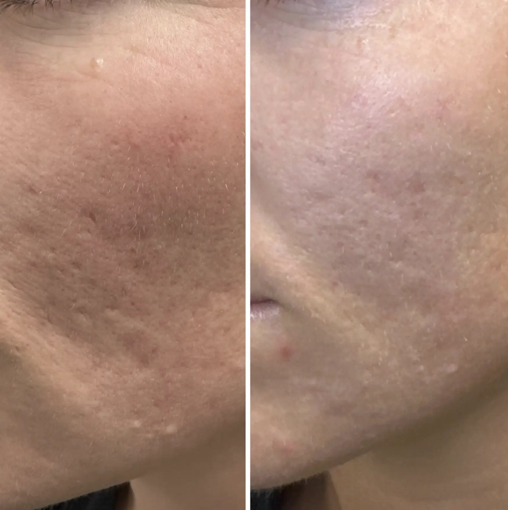 is it possible to completely remove acne scars