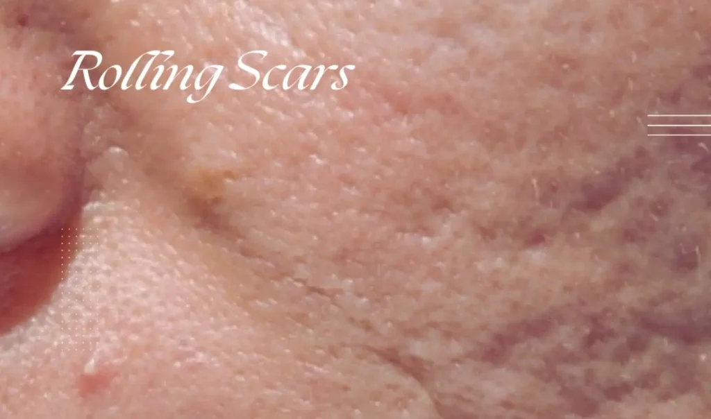 laser treatments for acne scars results