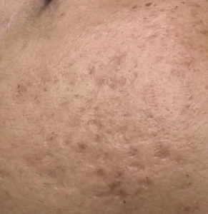 Read more about the article Can You 100% Remove Acne Scars?