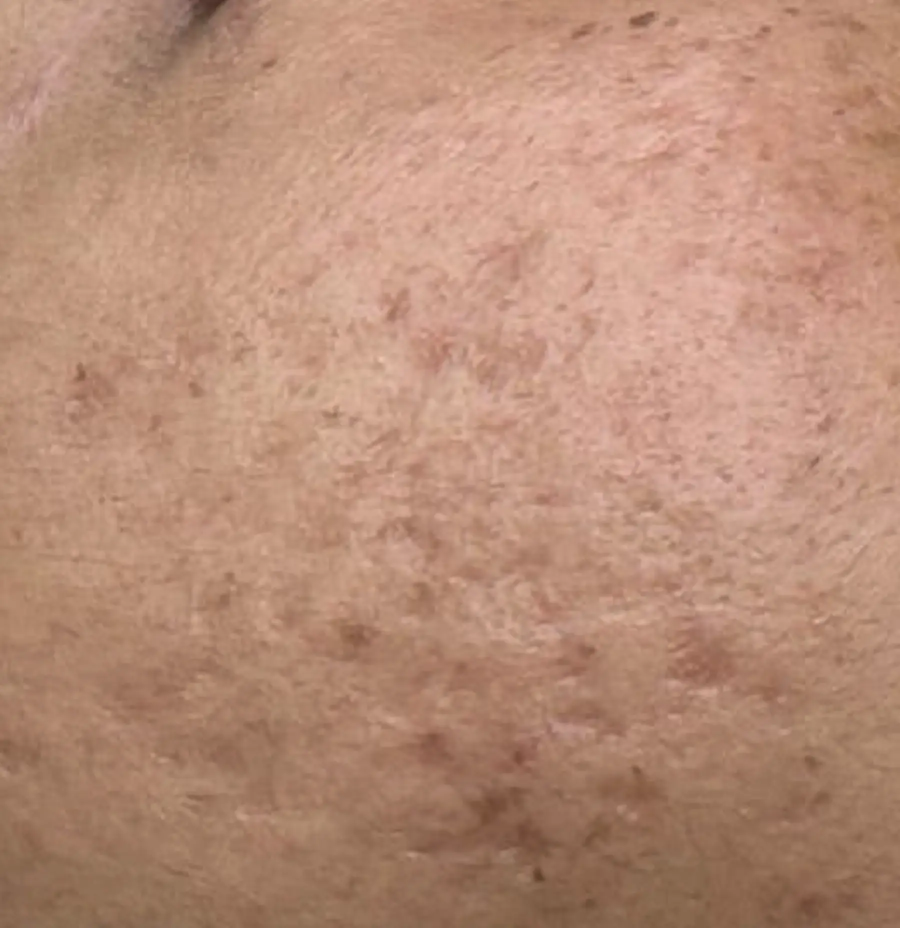 Read more about the article Can You 100% Remove Acne Scars?